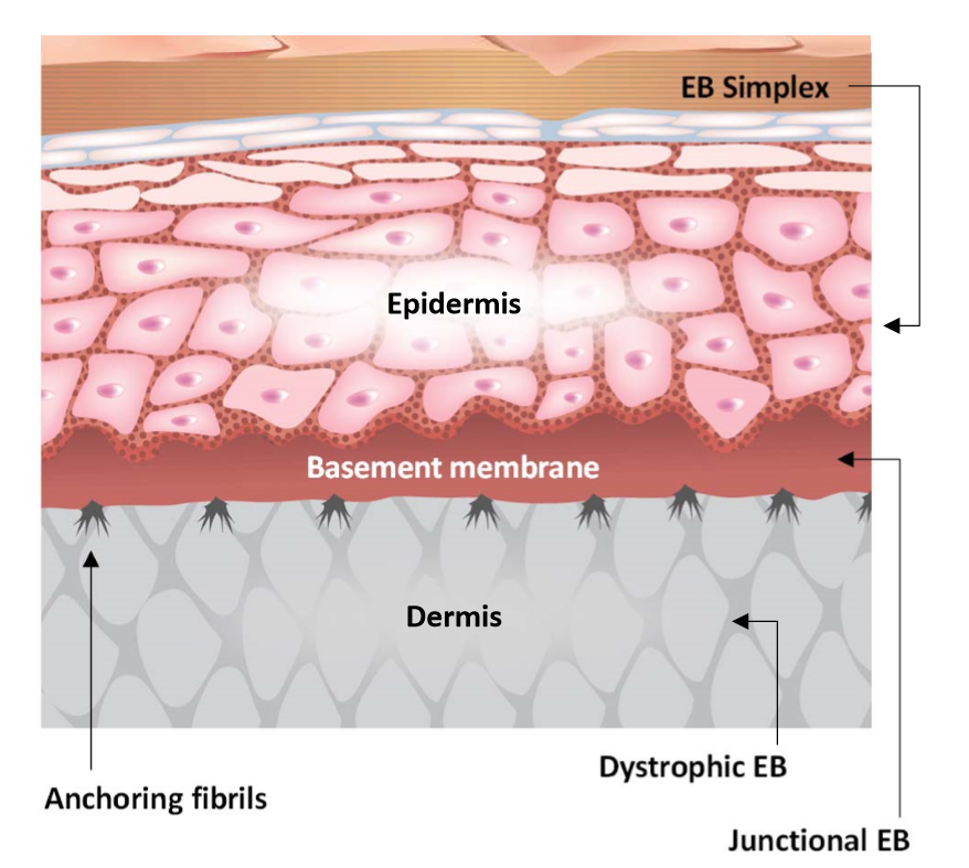 Stem cells cure deadly human skin disease - European Biotechnology