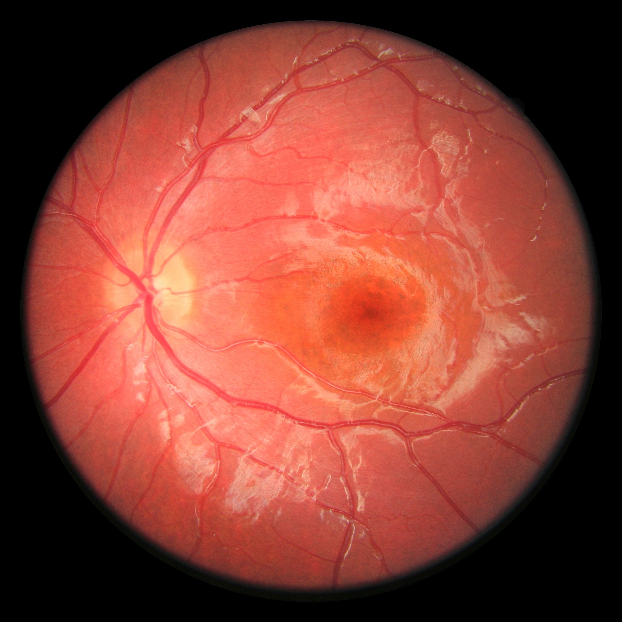retina eye