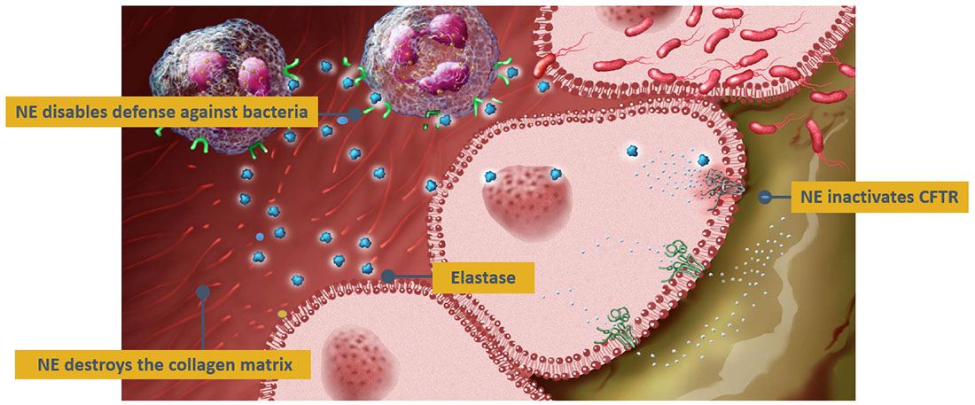 Polyphor Santhera licenses CF drug from Polyphor - European Biotechnology Magazine