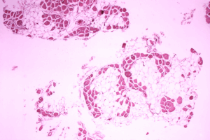 Microscopic image of cross-sectional calf muscle from a person with Duchenne muscular dystrophy, showing extensive replacement of muscle fibers by fat cells.