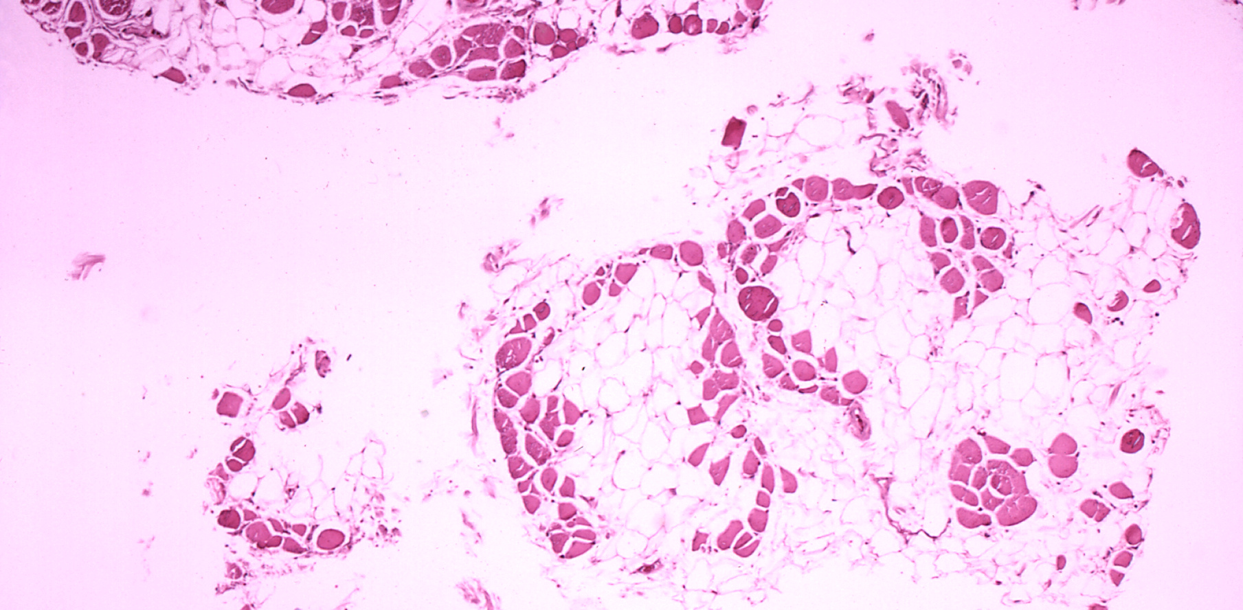 Microscopic image of cross-sectional calf muscle from a person with Duchenne muscular dystrophy, showing extensive replacement of muscle fibers by fat cells.