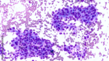 Microscopic image showing cancer cells (cytology) of adenocarcinoma of lung.