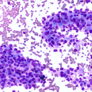 Microscopic image showing cancer cells (cytology) of adenocarcinoma of lung.