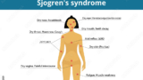 Sjögren's syndrome symptoms