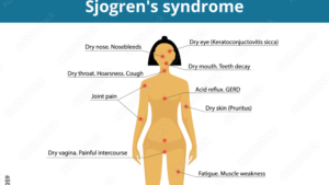 Sjögren's syndrome symptoms