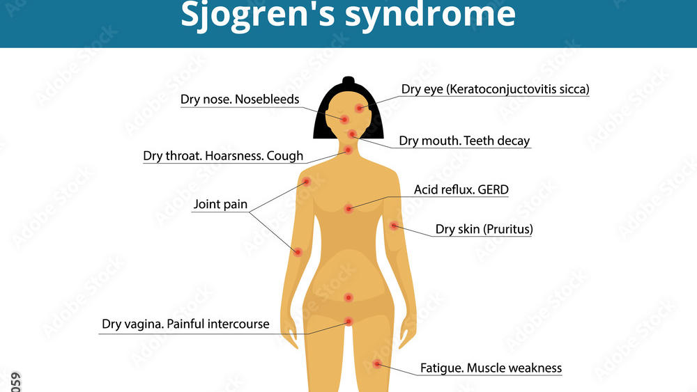 Sjögren's syndrome symptoms