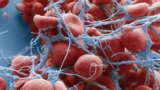 Thrombosis under electron microscope