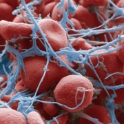 Thrombosis under electron microscope
