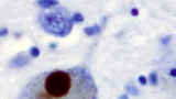 Alpha-Synuclein staining of a Lewy body in the substantia nigra in Parkinson's disease.