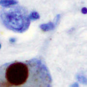 Alpha-Synuclein staining of a Lewy body in the substantia nigra in Parkinson's disease.