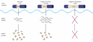 The Fragile X mutation is a type of genetic mutation called a repeat expansion. This repeat expansion occurs on the FMR1 gene, on the long arm of the X chromosome leading to gene silencing if more than 200 repeats occur.