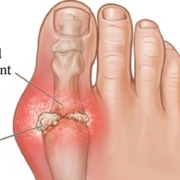 Schematic of uric acid crystal formation and swallowing