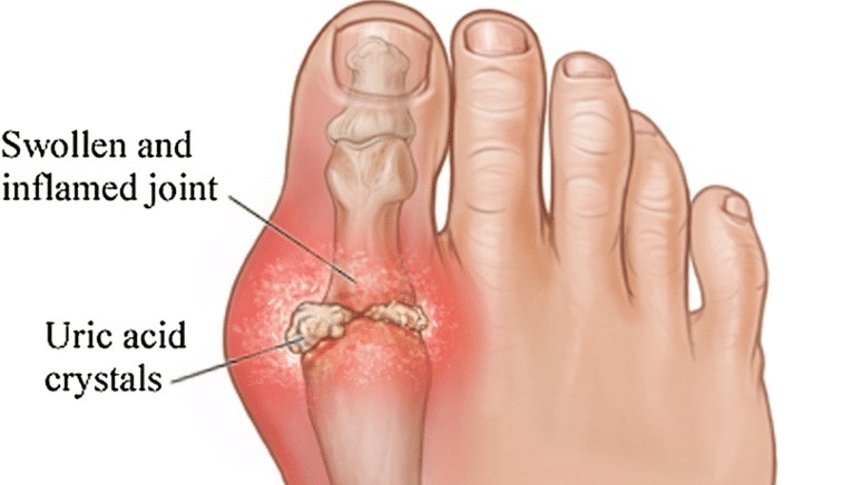 Gout_illustration Schematic of uric acid crystal formation and swallowing