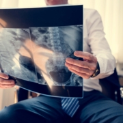 Boehringer cystic fibrosis Boehringer cystic fibrosis