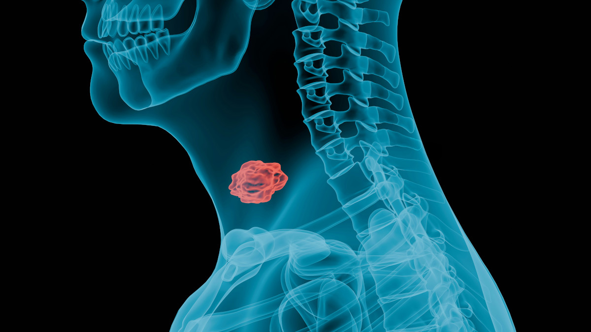 TenBoron lands €7.6m EU grant for precision radiotherapy trials in hard-to-treat cancers