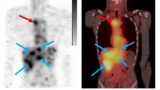 Initial high blood pool was followed by specific uptake in primary (red arrow) & metastatic lesions (blue) after 116h in line with MP0712 MoA