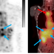 Initial high blood pool was followed by specific uptake in primary (red arrow) & metastatic lesions (blue) after 116h in line with MP0712 MoA