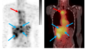 Initial high blood pool was followed by specific uptake in primary (red arrow) & metastatic lesions (blue) after 116h in line with MP0712 MoA