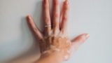 vitiligo skin disease
