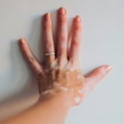 vitiligo skin disease