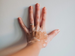 vitiligo skin disease