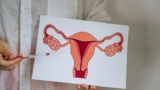 ovarian cancer