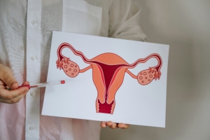 ovarian cancer ovarian cancer