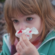 Different symptoms come with Hereditary Hemorrhagic Telangiectasia: chronic nose bleeding (epistaxis) shows up in 90% of patients, but Internal arteriovenous malformation (AVM) in other organs like brain or liver are source of severe issues like stroke, hypertension and heart illness.