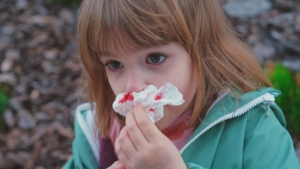 Different symptoms come with Hereditary Hemorrhagic Telangiectasia: chronic nose bleeding (epistaxis) shows up in 90% of patients, but Internal arteriovenous malformation (AVM) in other organs like brain or liver are source of severe issues like stroke, hypertension and heart illness.