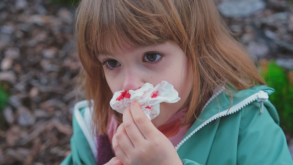 Different symptoms come with Hereditary Hemorrhagic Telangiectasia: chronic nose bleeding (epistaxis) shows up in 90% of patients, but Internal arteriovenous malformation (AVM) in other organs like brain or liver are source of severe issues like stroke, hypertension and heart illness.