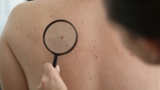 skin cancer prevention