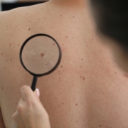 skin cancer prevention