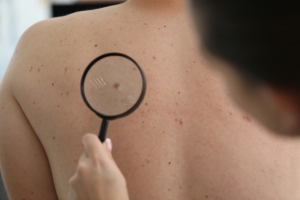 skin cancer prevention